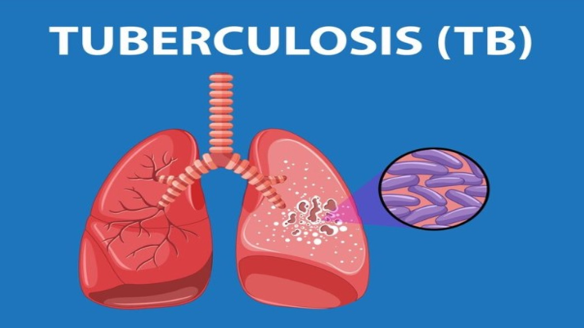 Pemerintah Kejar Eliminasi Tuberkulosis di Indonesia pada Tahun 2030